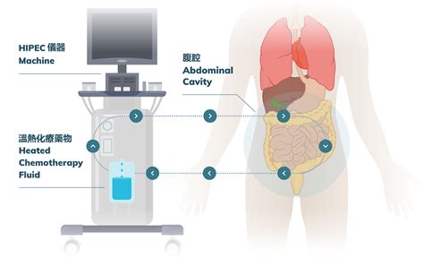Image result for HIPEC Machine