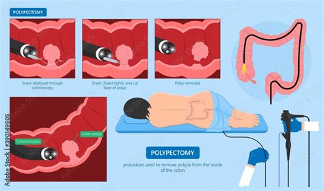 Image result for Colonoscopy Polypectomy