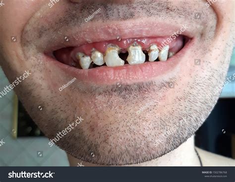 Image result for Tooth Hole