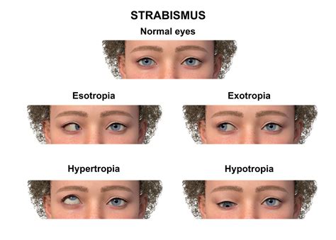 Strabismus Explained: What You Need to Know About Crossed Eyes ...