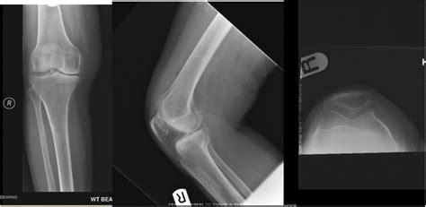 Total knee arthroplasty in a patient with a fused ipsilateral hip ...