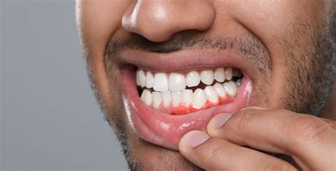 Gum Recession Treatment: Options to Restore Your Gum Health - Aspendale Gardens Dental Care