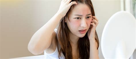 Rosacea Treatment in Faridabad, Chhattarpur | Skination Clinic