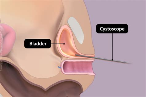 Image result for Videocystometrogram Procedure