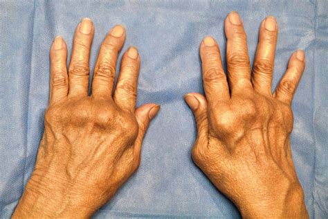 CODAES - Artritis Reumatoide