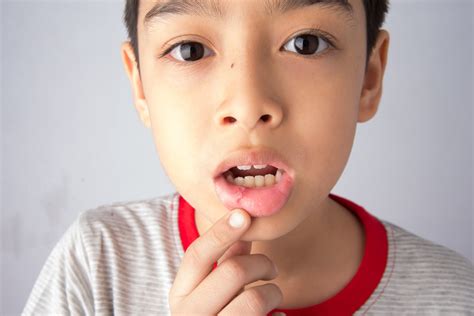 Canker Sore On Lip Should You Try To Pop A Canker Sore? NewMouth