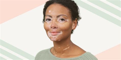 Best Vitiligo Treatment | Vitiligo Cure | Leucoderma Treatment