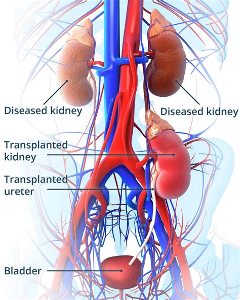 Kidney Transplant Procedure