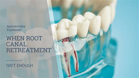 apicoectomy explained after failed root canal Archives - Eastern Idaho Endodontics