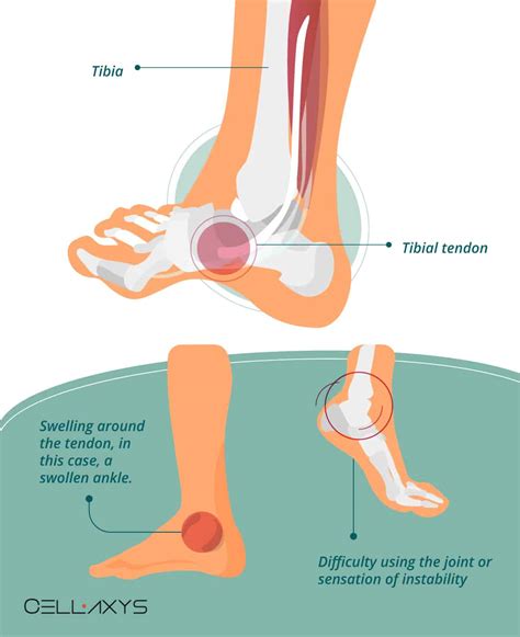 How To Decrease Your Posterior Tibial Tendonitis Recovery Time? - Cellaxys