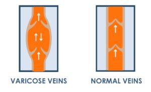 Varicose Veins Treatment: Home Remedies, Natural, One day Cure|Medfin