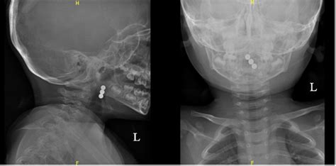 Magnetic beads - hazardous beauty | Pediatric Oncall Journal