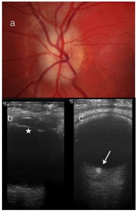 Optical Disc Drusen at Matthew Fisken blog