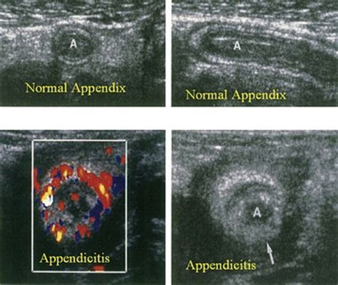Image result for Normal Appendix Appearance