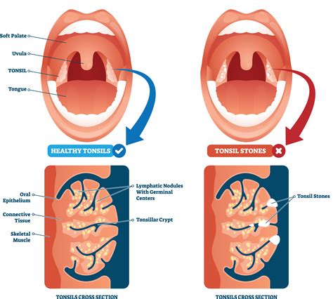 Palatine Tonsil Healthy