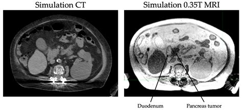 What Does Pancreatic Cancer Look Like On Mri at Heather Carlson blog