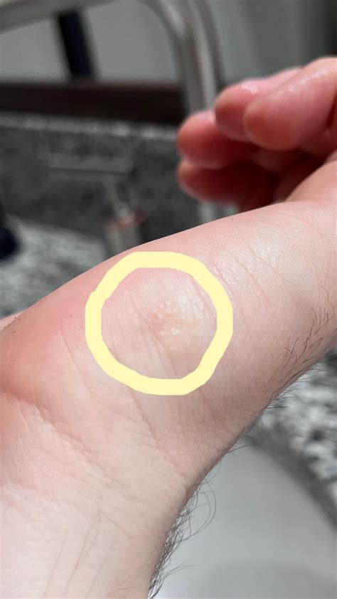 Small cluster of bumps on outside of hand : r/DermatologyQuestions