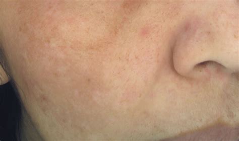 cosmelan® depigmenting professional treatment blemish treatment|...