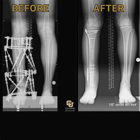 Comprehensive Orthopedic Services for Trauma and Limb Restoration | Jason Stoneback, MD, Aurora, CO