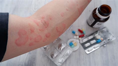 Обновленные рекомендации AAAAI по лечению атопического дерматита ...