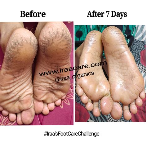 IRAA’S FOOT MAGIC – Iraa Organics