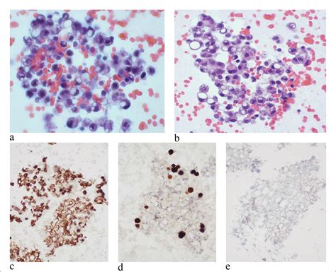 Cytologic diagnosis and differential diagnosis of histiocytic signet ring cells in effusion ...