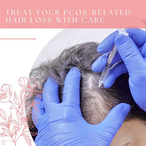 How to Treat PCOS-Related Hair Loss (Doctor's Guide) | Clinikally