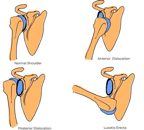 Shoulder Dislocation Contortion 的图像结果