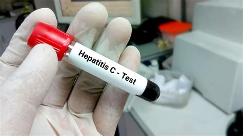 Hep C Test 的图像结果