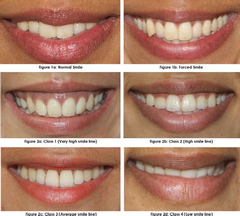 Figure 1 from Evaluation of Smile Line in Natural and Forced Smile ...