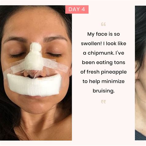 Nose Job Recovery Bruising