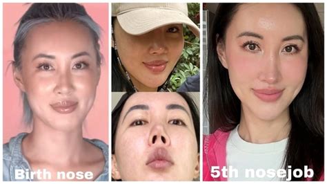 Woman spends ₹1 crore on 4 nose jobs after botched rhinoplasty surgery ...