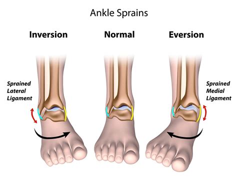 Zilaxo Advanced Pain Solution: Simple Ways To Treat A Sprained Ankle