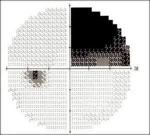 Image result for Check Visual Fields