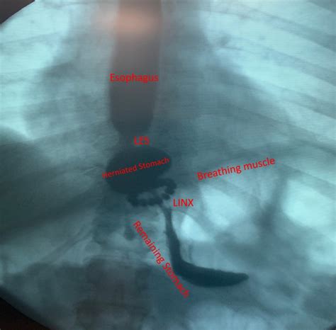 Image result for Linx Device