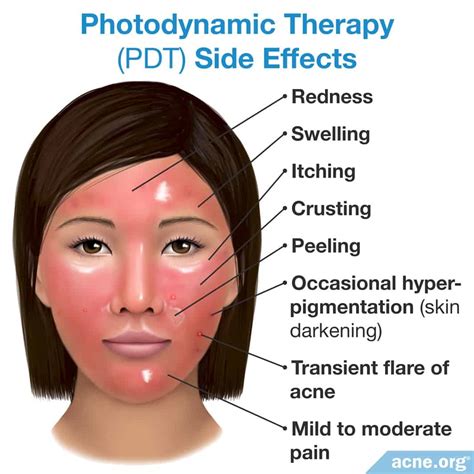 Light Therapy For Skin Cancer at James Aviles blog