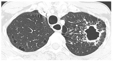 Chest Imaging in Systemic Endemic Mycoses