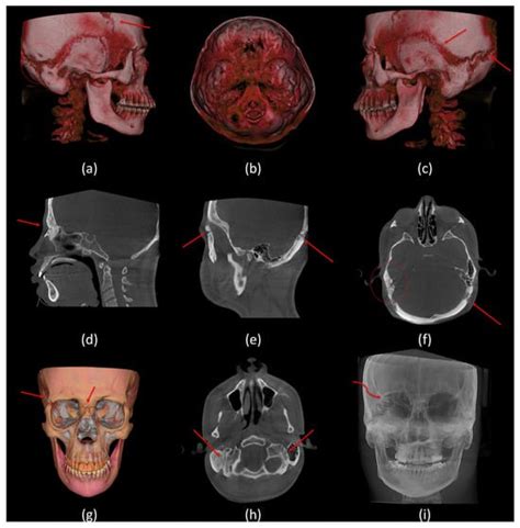 Craniofacial and Airway Morphology in Down Syndrome: A Cone Beam ...