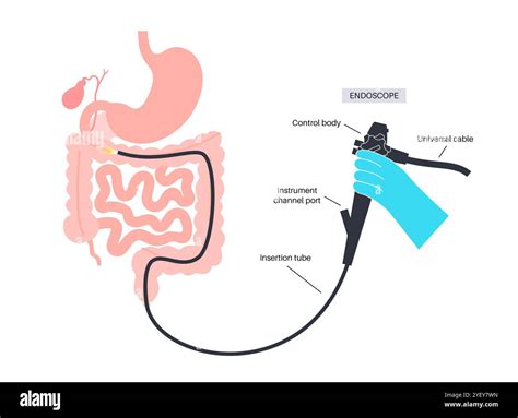 Conceptual illustration of a colonoscopy procedure. This is an examination of the inside of your ...