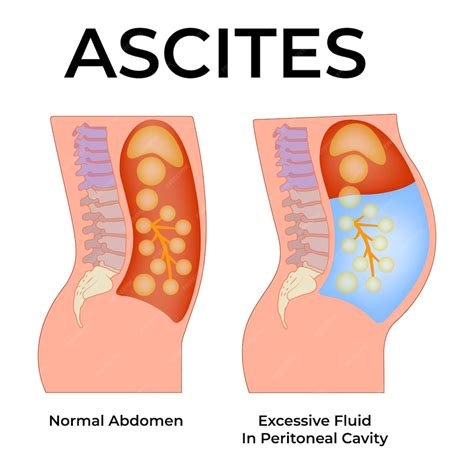 Ascites normal abdomen excessive fluid in peritoneal cavity vector ...