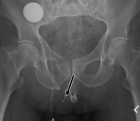 CT and MR Imaging Features of Artificial Urinary Sphincters, Penile Prostheses, and Other ...