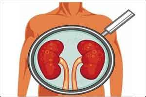 Novel treatment benefits patients with metabolic acidosis and kidney ...