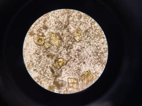 [4000x3000 pix] Amorphous urates (brown sand) and uric acid crystals ...