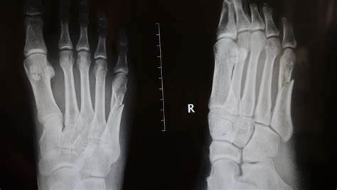小脚趾骨折，请问这种情况算不算是骨折移位。不加钢针连接治疗会不会痊愈？现在已经听医生打上了石膏。_百度知道