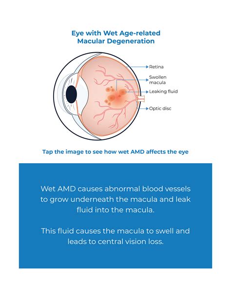 WAMD - Wet Age Related Macular Degeneration - Kodiak Sciences