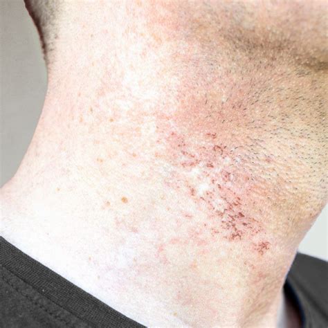 How to Beat Shaving Rash | The Complete Guide | Lane44 – Lane 44