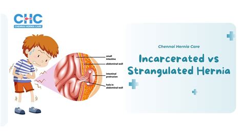 Incarcerated vs Strangulated Hernia