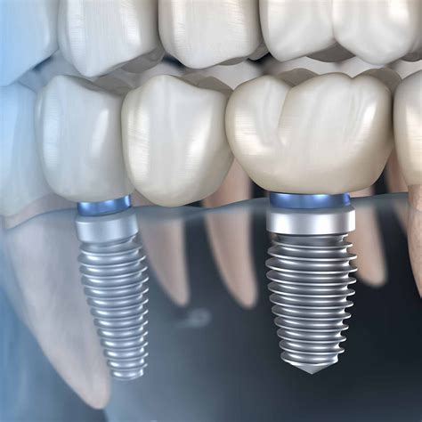 Nuvia Dental Implants: A Comprehensive Guide to Costs and Benefits for ...