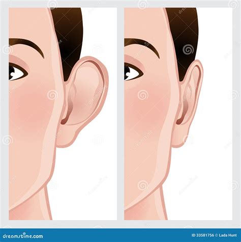 Ear Pinning, Otoplasty stock illustration. Illustration of pinning - 33581756