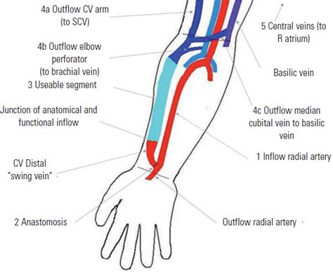 Duplex ultrasound scanning of the autogenous arterio venous ...